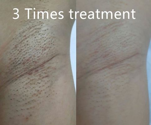 多機能ダイオードレーザー脱毛装置 パーマンテンの脱毛のために 異なるパルス幅をサポートする